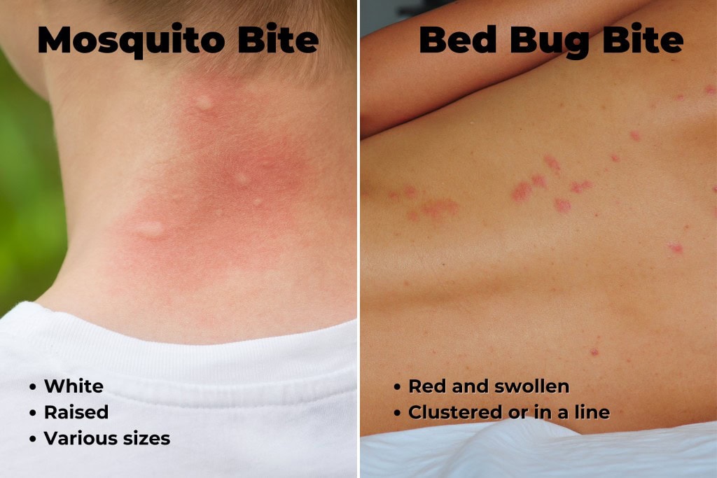 mosquito-bite-vs-bed-bug-bite-Absolute Pest Solutions